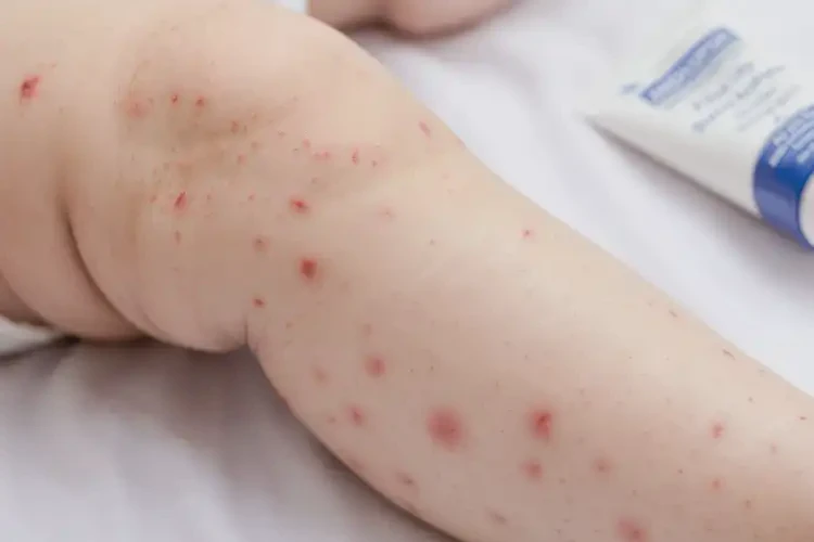 嬰幼兒小腿上出現(xiàn)濕疹不管它會(huì)自己自愈嗎(圖3)