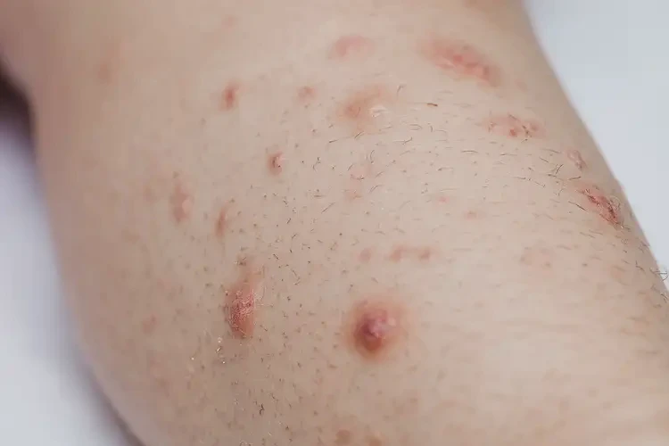 兒童小腿有濕疹不管它會自己好嗎(圖4)