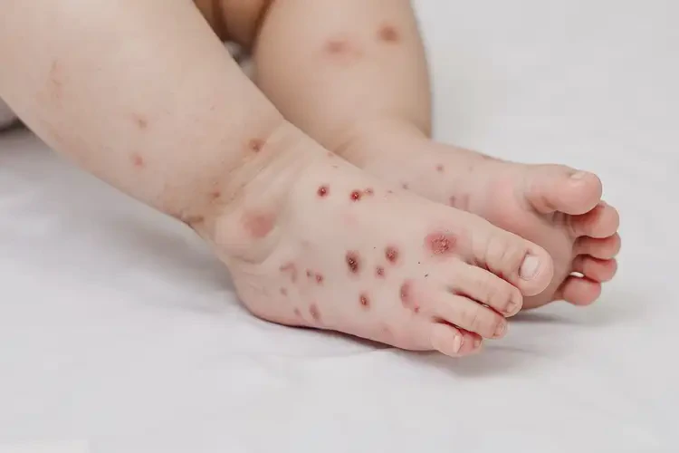 幼兒腳上起濕疹可不可以根治(圖4)