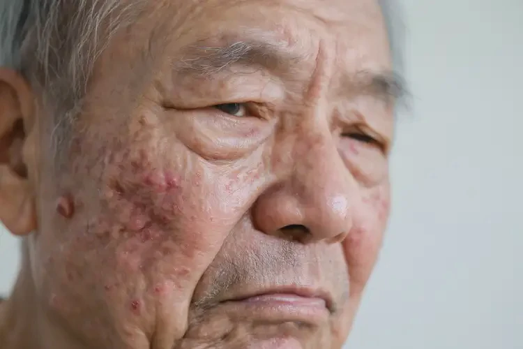 老年人面部出现湿疹不管它会自己痊愈吗(图2)