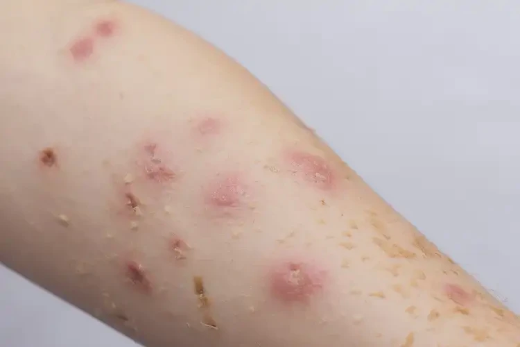 中學(xué)生手臂上容易長(zhǎng)濕疹可不可以根治(圖4)