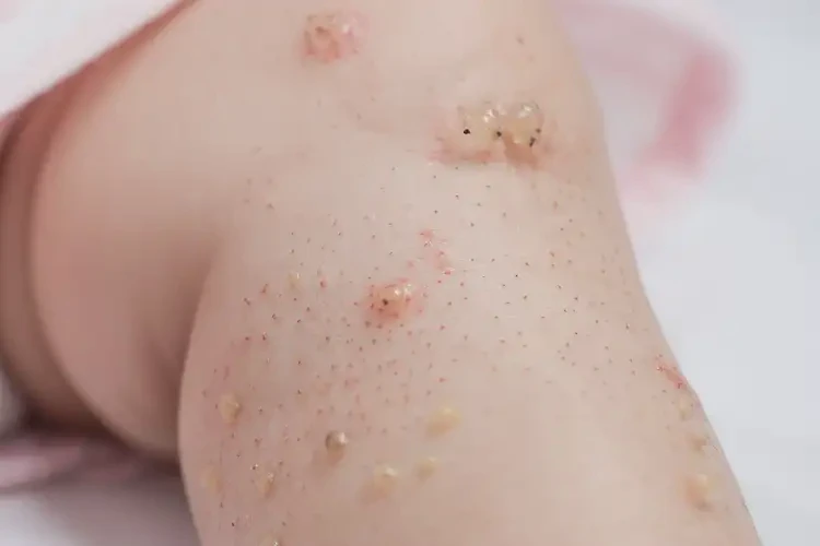 嬰幼兒小腿容易長濕疹不管它會自己好嗎(圖4)