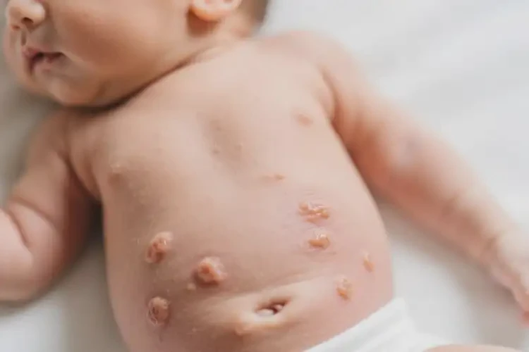 新生儿肚子上出现湿疹可不可以根治(图4)