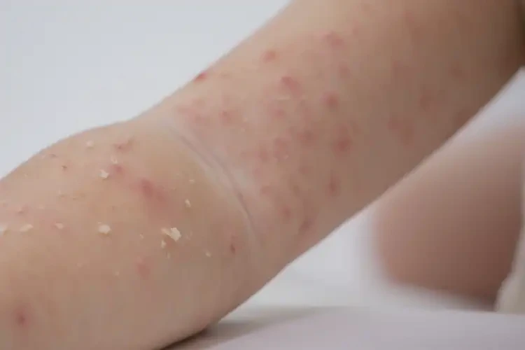 兒童身上容易長(zhǎng)濕疹不管它會(huì)自己痊愈嗎(圖4)