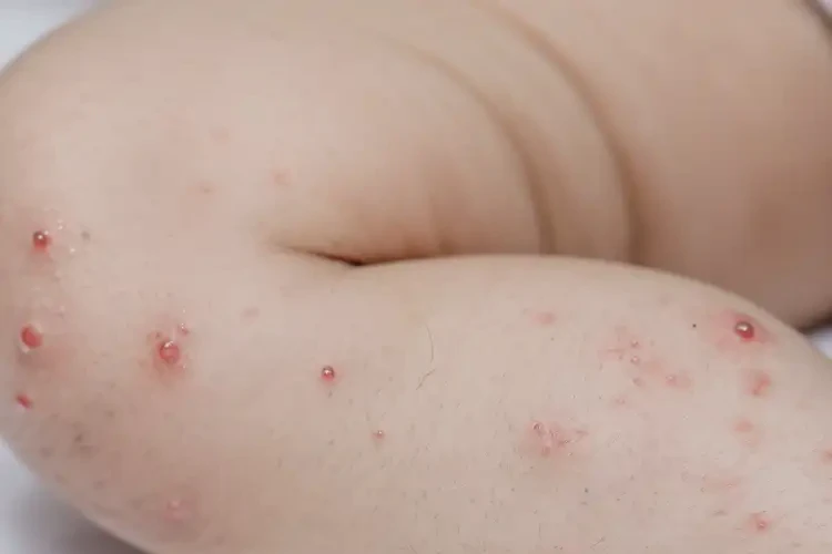 少兒小腿上偶爾長(zhǎng)濕疹可不可以根治(圖4)