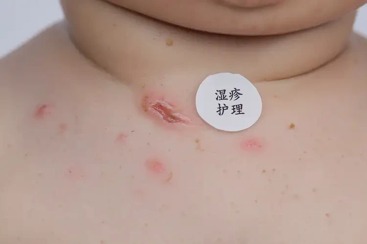 嬰幼兒脖子上起濕疹可不可以根治(圖4)