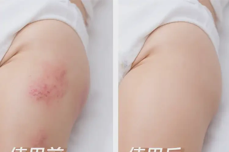 新生兒屁股上出濕疹可不可以徹底自愈(圖2)