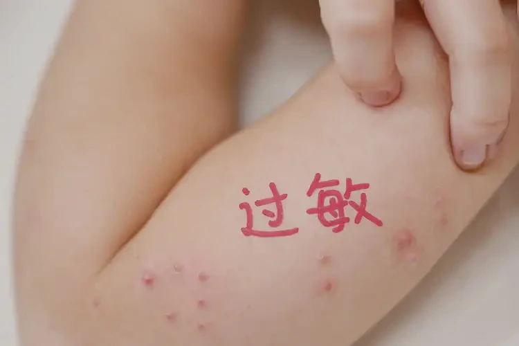 孩子肛周起濕疹不管它會(huì)自己自愈嗎(圖4)