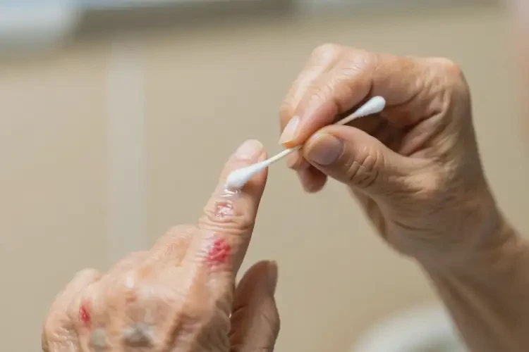 老人手上容易起濕疹可不可以根治(圖3)