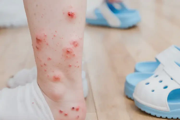 少儿脚上偶尔长湿疹能够彻底治愈吗(图4)