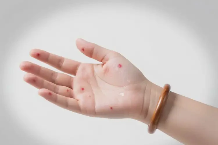 孕婦手上偶爾起濕疹能徹底自愈嗎(圖2)