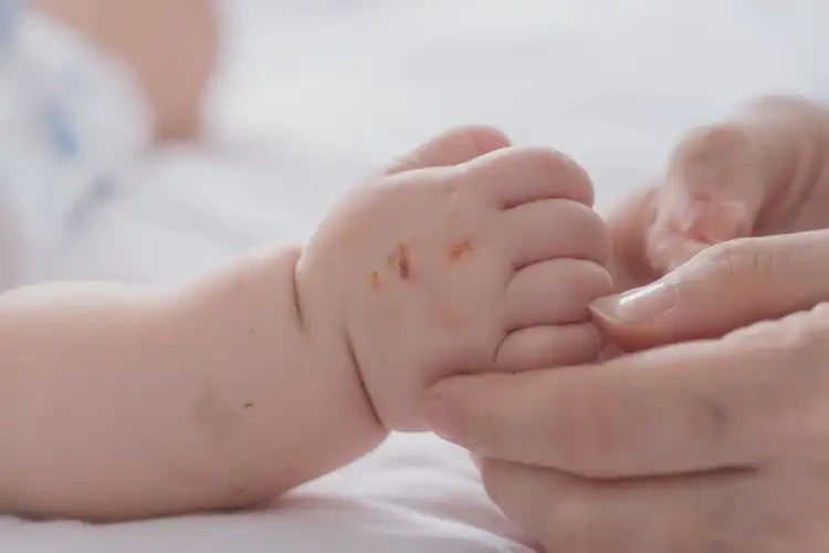 寶寶手上經(jīng)常長濕疹不管它會(huì)自己痊愈嗎(圖4)