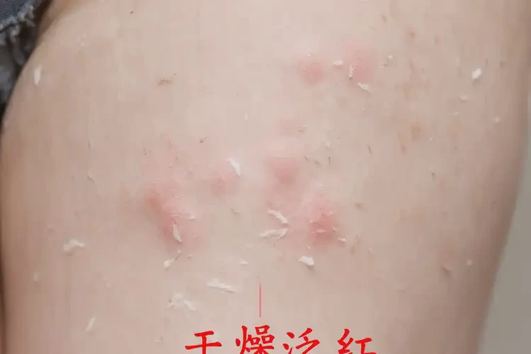 哺乳期妈妈小腿上经常长湿疹能不能根治(图4)