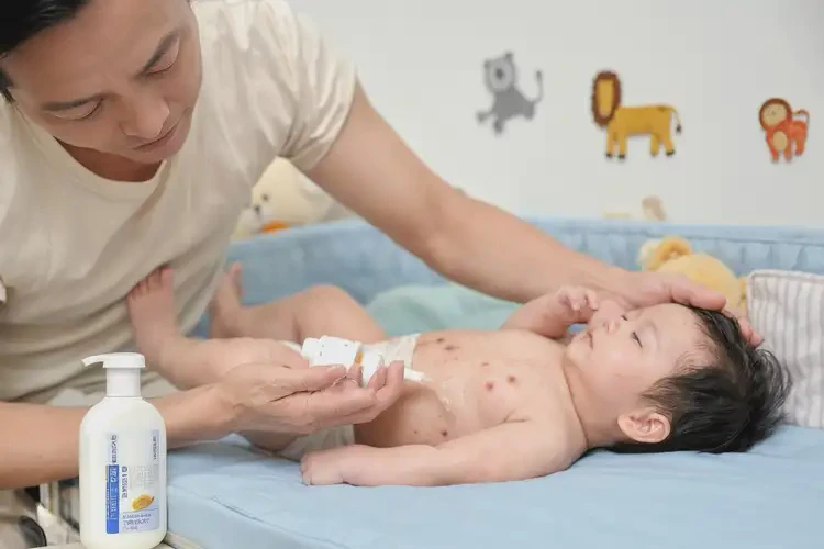 嬰幼兒身上容易起濕疹可以治好嗎(圖2)