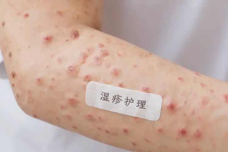 大學生手臂上經(jīng)常起濕疹可不可以根治(圖4)