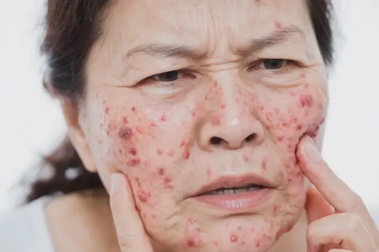 女人面部起湿疹不管它会自己好吗(图4)