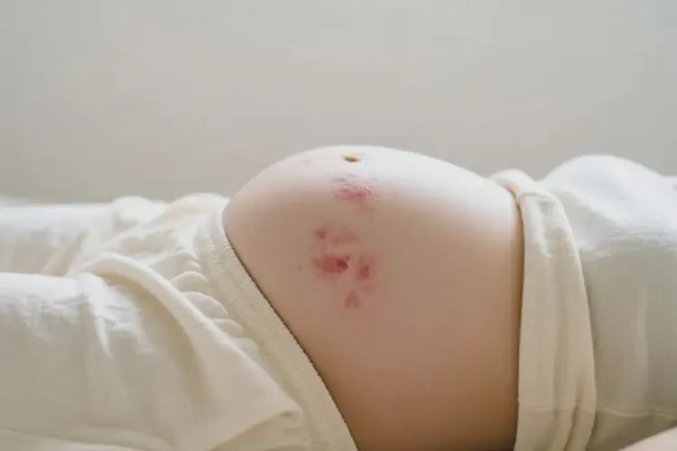 孕婦屁股上出濕疹可不可以根治(圖4)