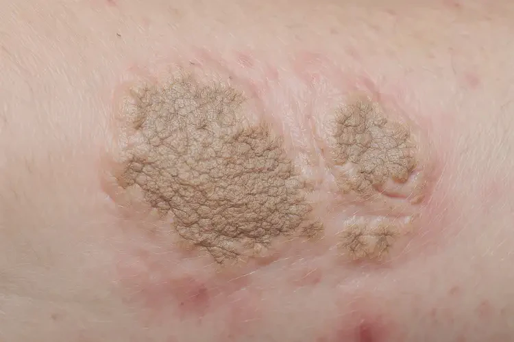 男人大腿上出濕疹可不可以徹底自愈(圖2)