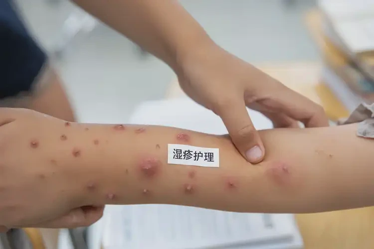 小学生手臂出湿疹可不可以根治(图4)