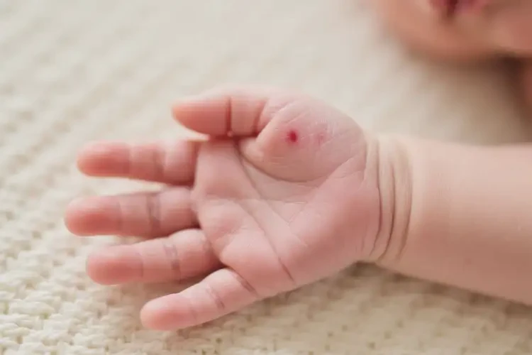 新生儿手上出湿疹可不可以根治(图2)