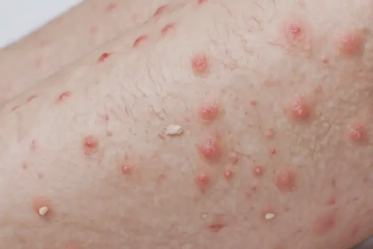 老年人小腿長濕疹可不可以根治(圖4)