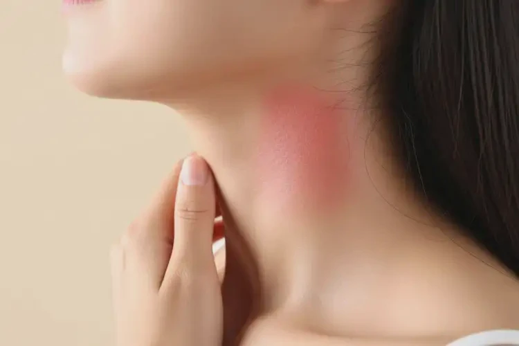 女性脖子長濕疹可不可以根治(圖3)