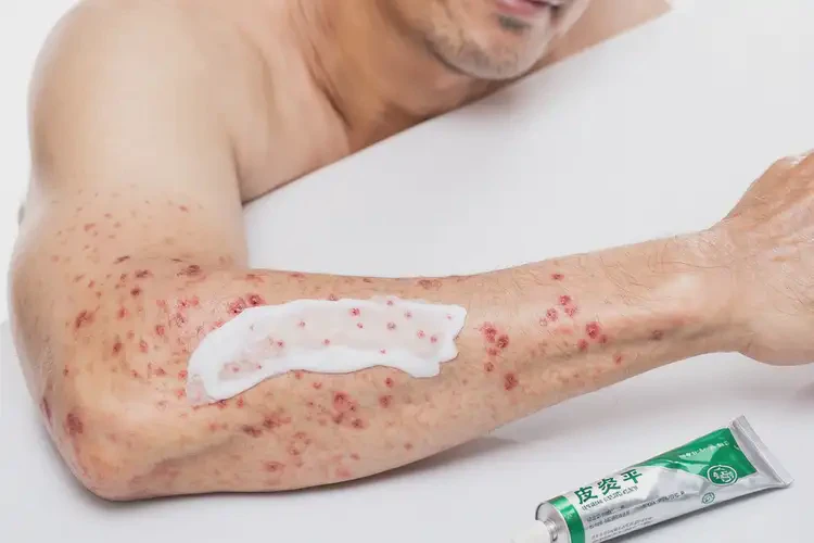 男人手臂上偶爾長濕疹能不能根治(圖3)