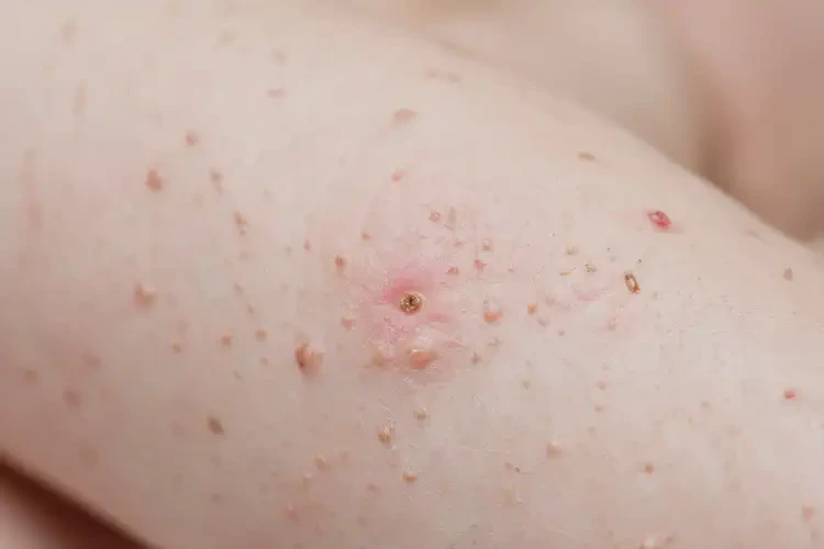 嬰幼兒身上容易起濕疹可以治好嗎(圖4)