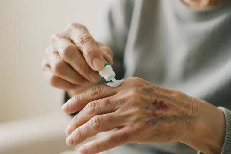 高齡老人手上偶爾長濕疹能不能根治(圖3)