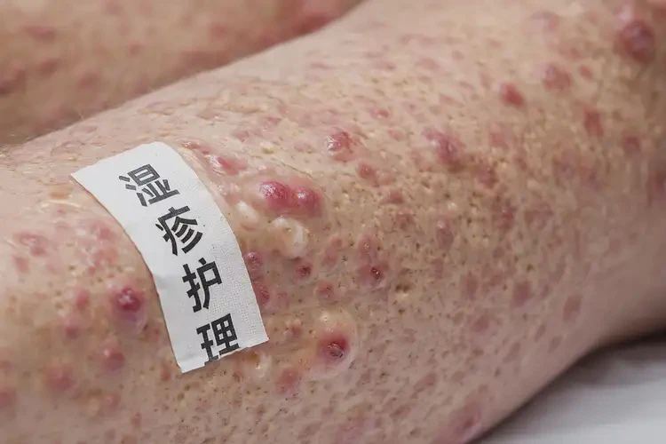 高齡老人小腿出濕疹不管它會自己痊愈嗎(圖4)