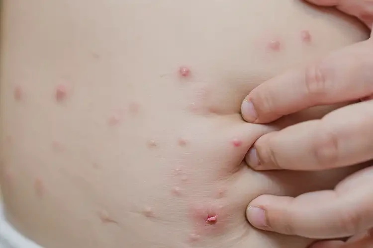 幼儿肚子容易起湿疹可不可以彻底自愈(图4)