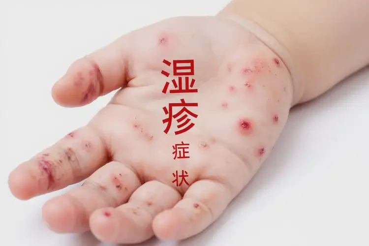 少兒手上偶爾長濕疹可不可以根治(圖4)