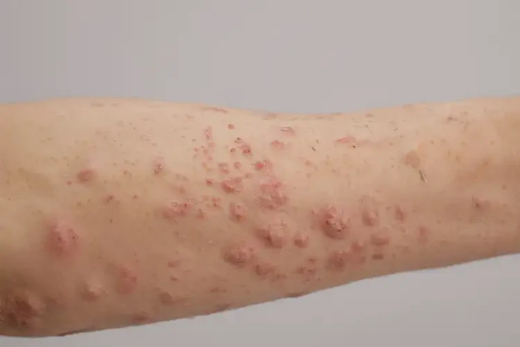 中學(xué)生手臂上容易起濕疹可以徹底自愈嗎(圖4)