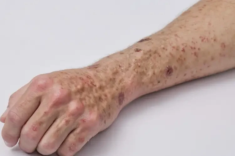 大学生手臂长湿疹能不能彻底自愈(图2)
