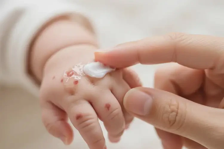 嬰兒全身起濕疹可不可以根治(圖1)