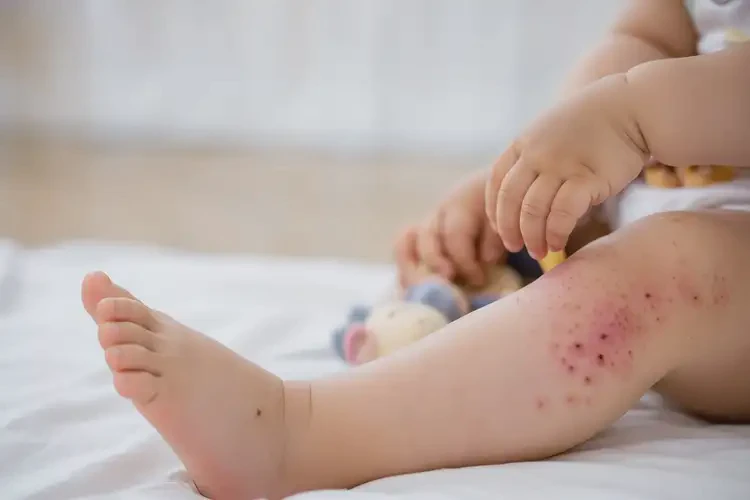 幼兒大腿偶爾長濕疹可不可以根治(圖4)