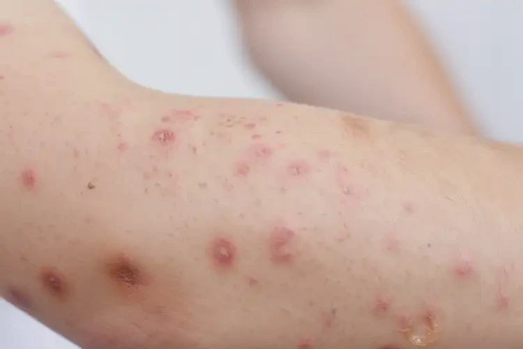 青少年手臂上出湿疹可不可以根治(图4)