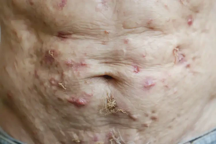 高齡老人肚子長濕疹可不可以根治(圖4)