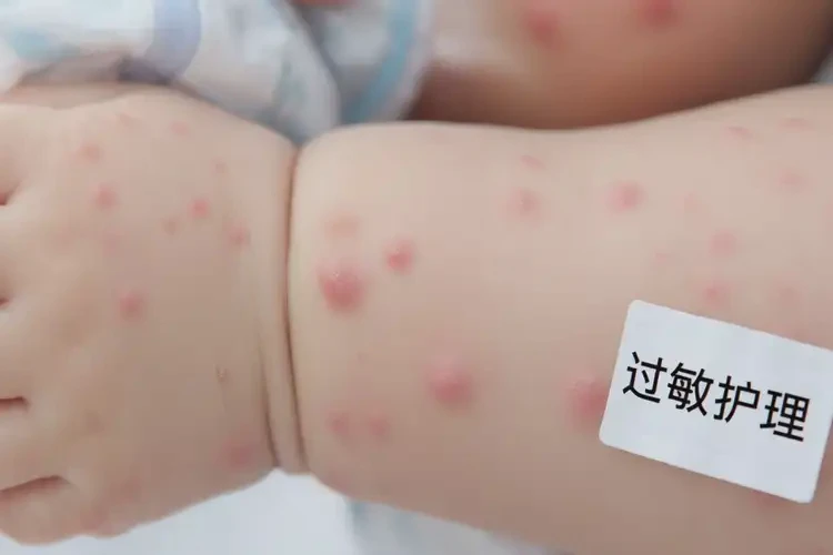 嬰兒手臂偶爾長(zhǎng)濕疹可不可以根治(圖4)