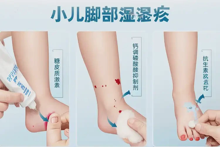 小兒腳上偶爾長濕疹可不可以根治(圖4)