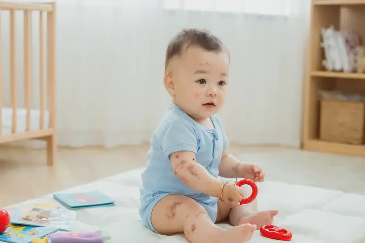 嬰幼兒手臂上偶爾長(zhǎng)濕疹可不可以根治(圖1)