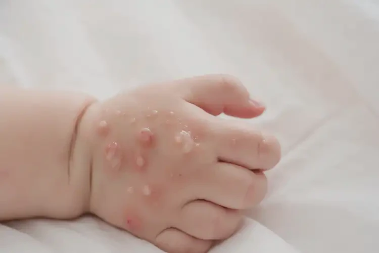 婴幼儿手上长湿疹不管它会自己痊愈吗(图3)