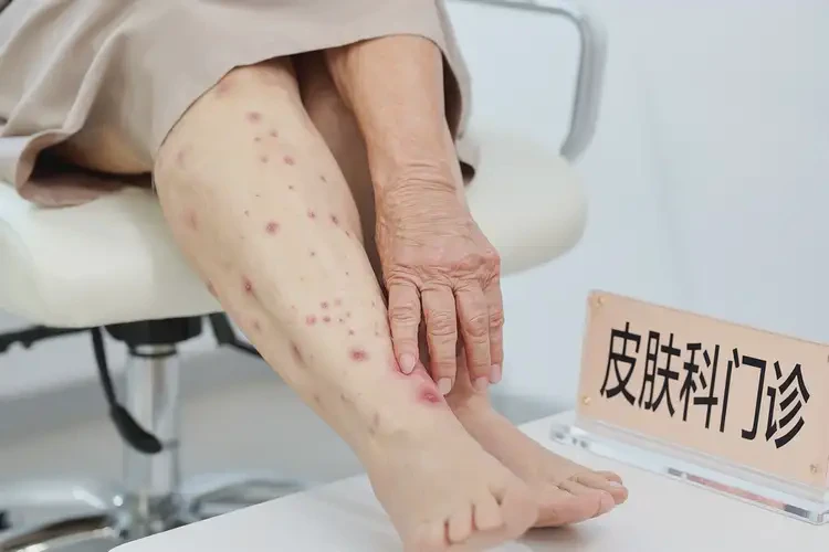 女性大腿容易起濕疹能靠自己自愈嗎(圖4)