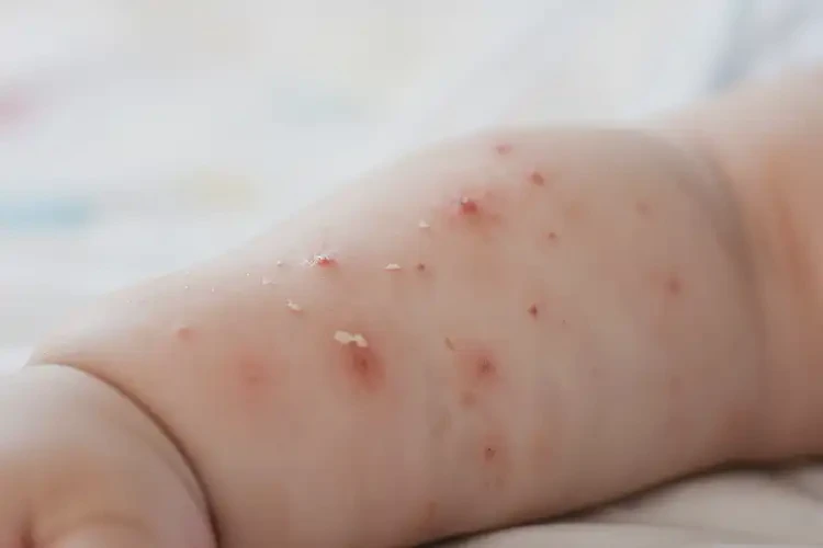 寶寶手臂有濕疹可以治好嗎(圖4)