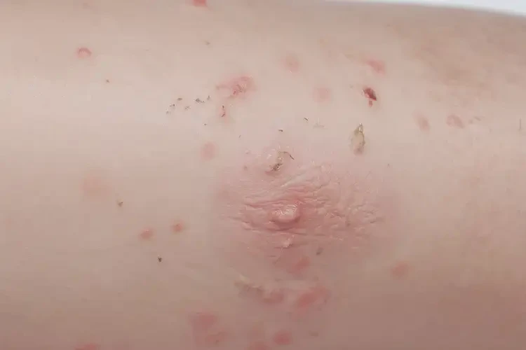 小孩小腿起濕疹可不可以根治(圖4)