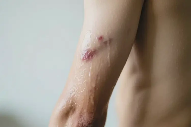 男生手臂經(jīng)常起濕疹可不可以根治(圖1)