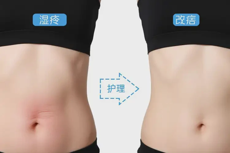 女性肚子上出現(xiàn)濕疹可不可以根治(圖3)