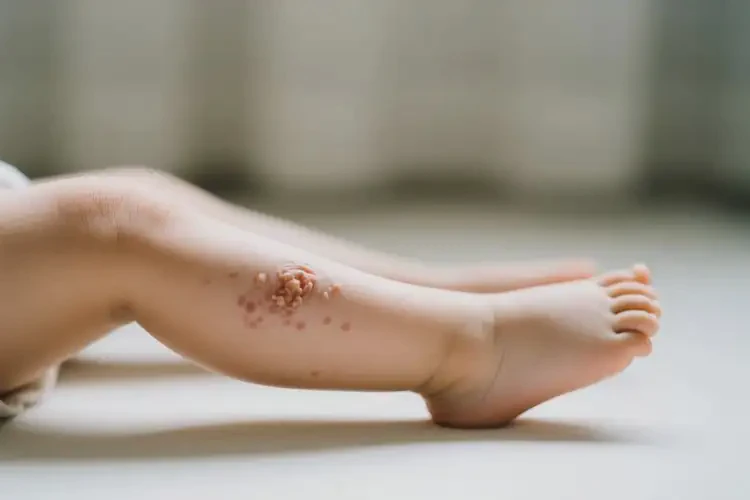 小孩大腿有濕疹可不可以根治(圖2)