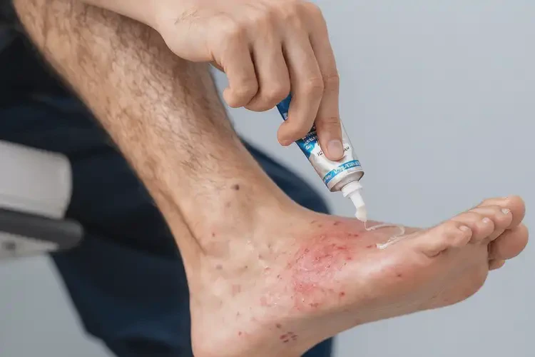 青年人脚上偶尔长湿疹可不可以根治(图3)