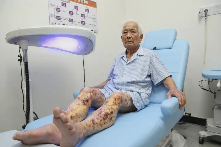 老人大腿上出現(xiàn)濕疹可不可以根治(圖1)